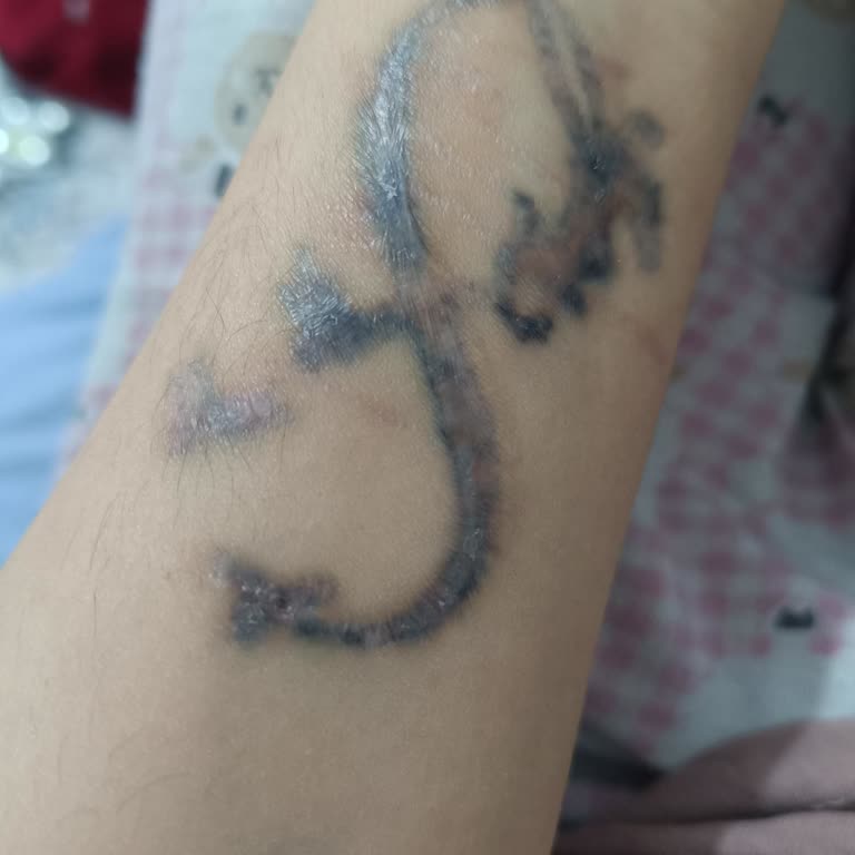 Dövme Silme İşleminde Hayal Kırıklığı Ve Yanık Sorunu