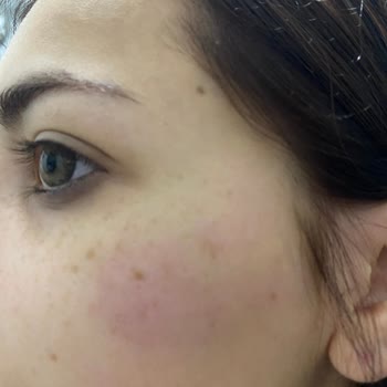 Saç Kremi Alerji Uyarısı Eksikliği Şikayeti