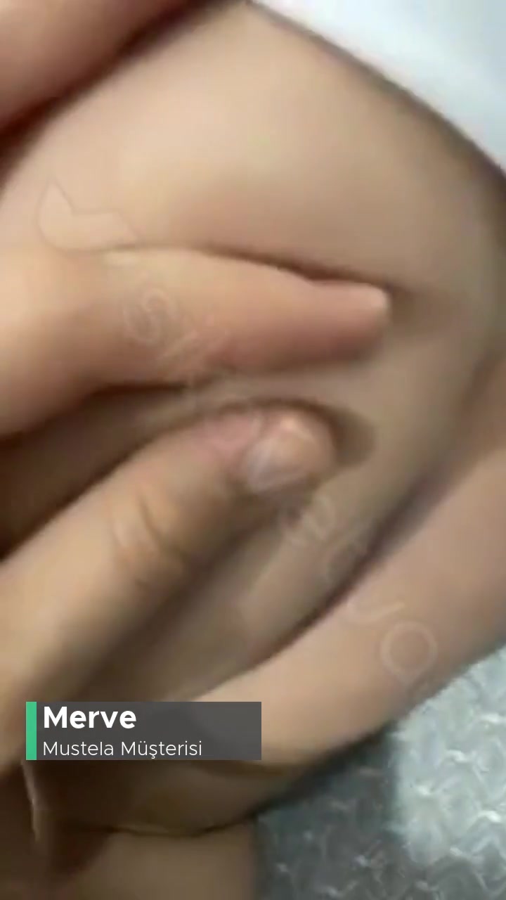 Mustela Pişik Kremi Beyaz Pütürcükler videonun kapak resmi
