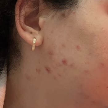 Sivilce Önleyici Ürünler Cildimi Mahvetti