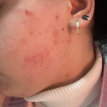 Sivilce Önleyici Ürünler Cildimi Mahvetti