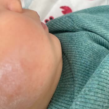 Bebek Şampuanı Kullanımı Sonrası Şok Edici Alerjik Reaksiyon