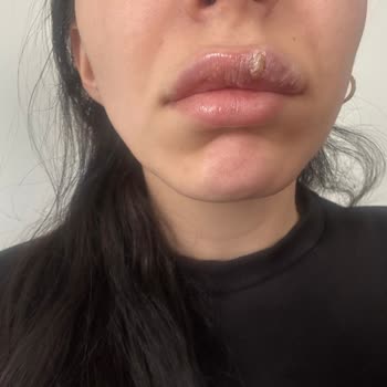 Dolgu Sonrası Yaşanan Sağlık Sorunları Ve Yanıltıcı Hizmet