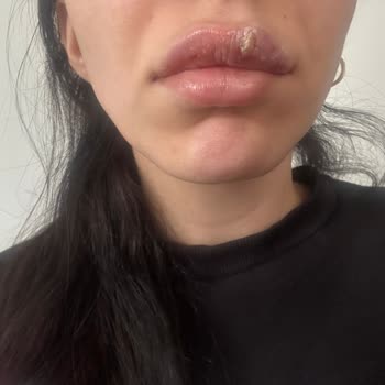 Dolgu Sonrası Yaşanan Sağlık Sorunları Ve Yanıltıcı Hizmet