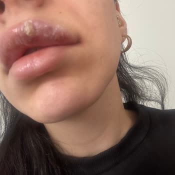 Dolgu Sonrası Yaşanan Sağlık Sorunları Ve Yanıltıcı Hizmet