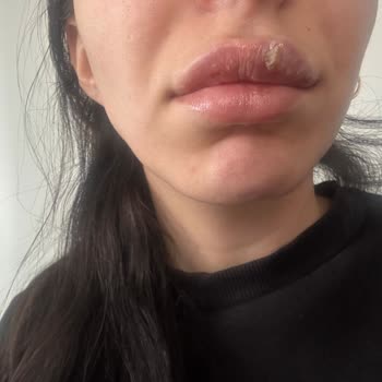 Dolgu Sonrası Yaşanan Sağlık Sorunları Ve Yanıltıcı Hizmet