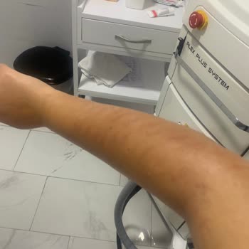 Yanlış Uygulama Sonucu Cilt Yanığı