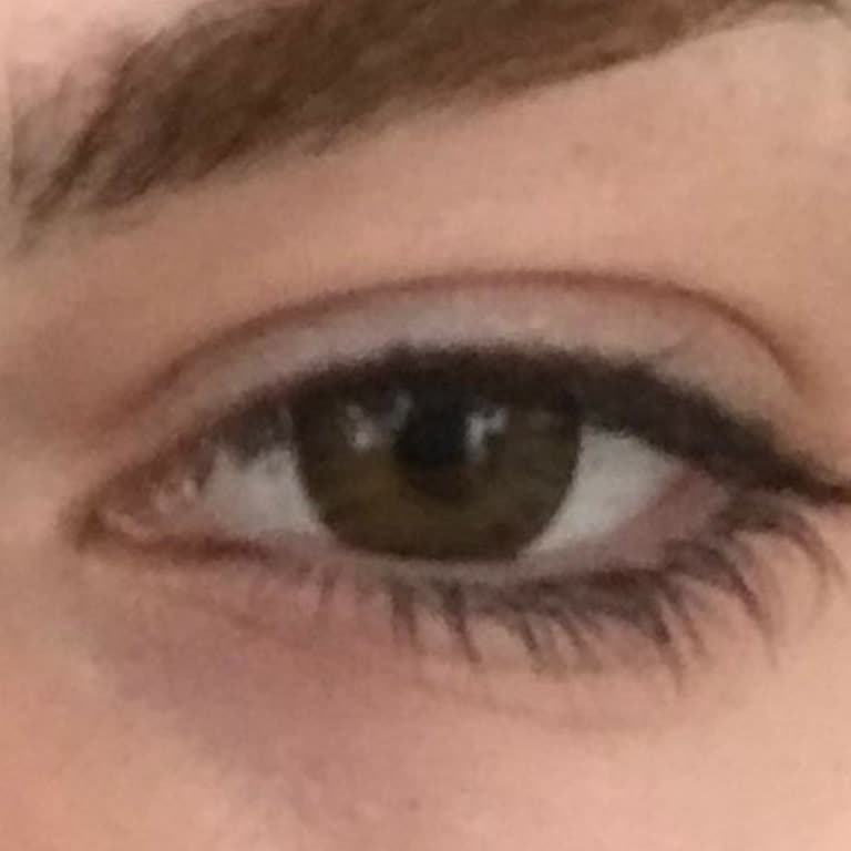 Lazer Epilasyon Ve Kirpik Lifting Hüsranı