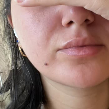 Origins Ginzing Serum Sample Caused Severe Skin Reaction