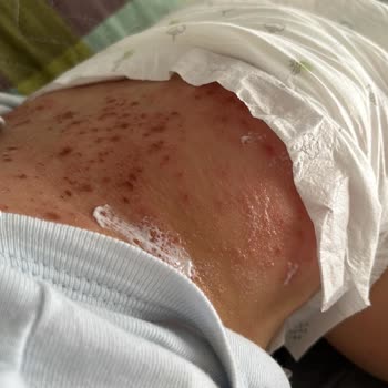 Sleepy Bebek Bezinden Kaynaklanan Alerji Kabusu!