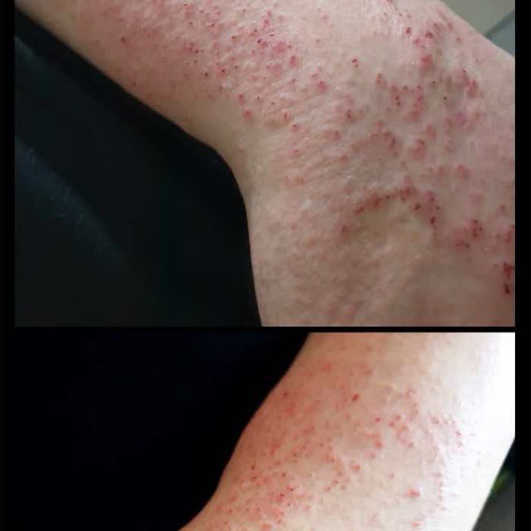 Bayer Claritine İlacın Yan Etkileri