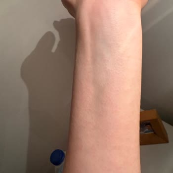 Mustela Stretch Mark Cream Caused Redness and Itching During Pregnancy