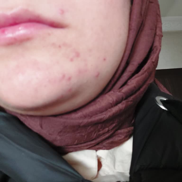 Bioderma Güneş Kremi Sivilce Sorunu