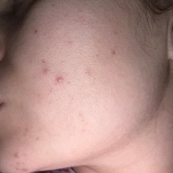 Estee Lauder Skincare Set Gave Me Breakouts and Worsened My Skin