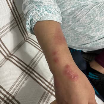 Hastane Odalarında Böcek Sorunu Ve İlgisizlik