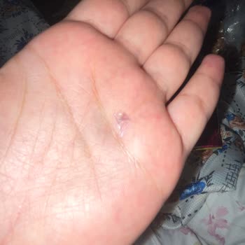 Çubuk Krakerde Tehlikeli Yabancı Madde