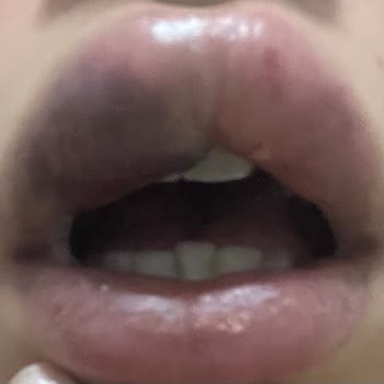 Melisa Ayhan Beauty Studio Dudağımı Mahvetti Bir De Üstüne Para Aldı