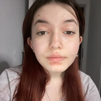 Nivea Makyaj Temizleme Suyu Sonrası Cilt Reaksiyonu