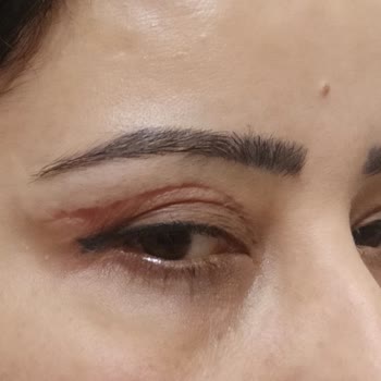 Medihaus Cerrahi Göz Kapağı Ameliyatından Memnun Kalmadım!