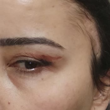 Medihaus Cerrahi Göz Kapağı Ameliyatından Memnun Kalmadım!