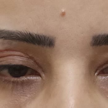 Medihaus Cerrahi Göz Kapağı Ameliyatından Memnun Kalmadım!