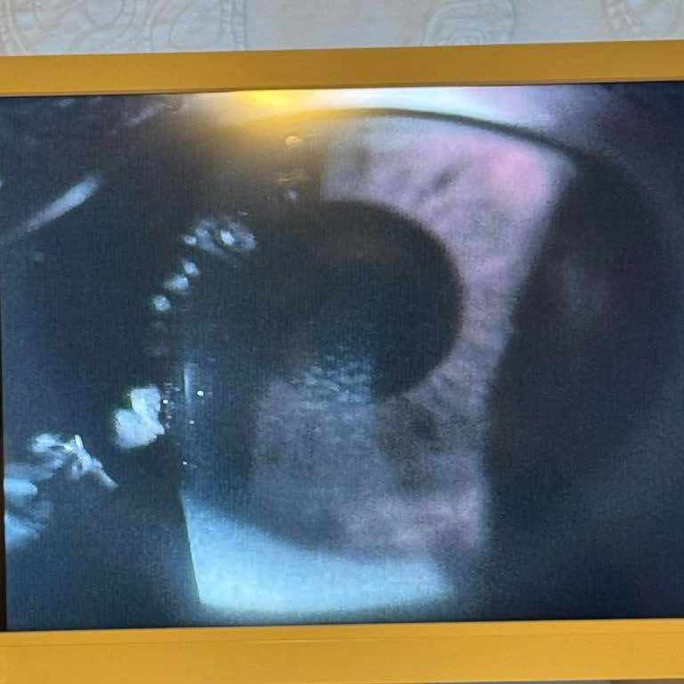 Sevgi Göz Merkezi (Adana) Lazer Ameliyatı Sonrası Beklenmedik Sorunlar