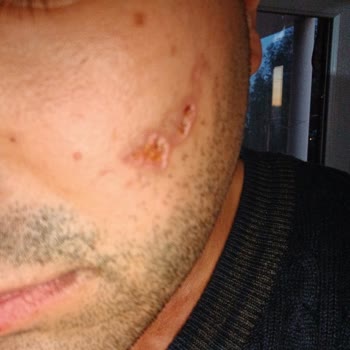 Lazer İşlemi Sonrası Yüzümde Yanık Ve Yara Oluştu