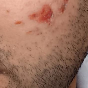 Lazer İşlemi Sonrası Yüzümde Yanık Ve Yara Oluştu