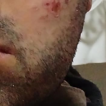 Lazer İşlemi Sonrası Yüzümde Yanık Ve Yara Oluştu