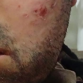 Lazer İşlemi Sonrası Yüzümde Yanık Ve Yara Oluştu