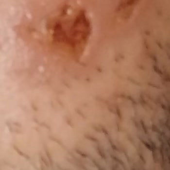 Lazer İşlemi Sonrası Yüzümde Yanık Ve Yara Oluştu