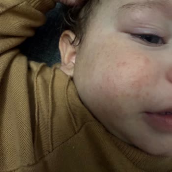 Bebeğimin Sağlığı Tehlikede: Mama Kaynaklı Cilt Sorunu