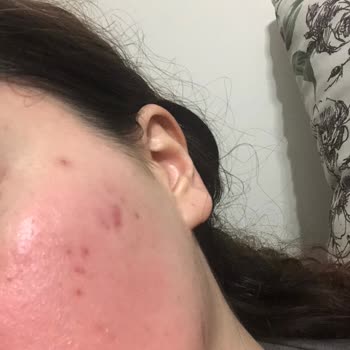 La Roche Posay Ürünleri Cildimde Yanma Ve Kızarıklık Yaptı