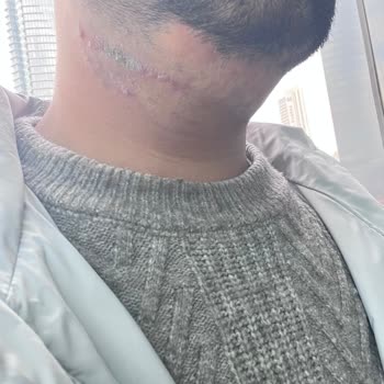 Lazer Epilasyonda Cilt Yanığı Ve Müşteri Memnuniyetsizliği