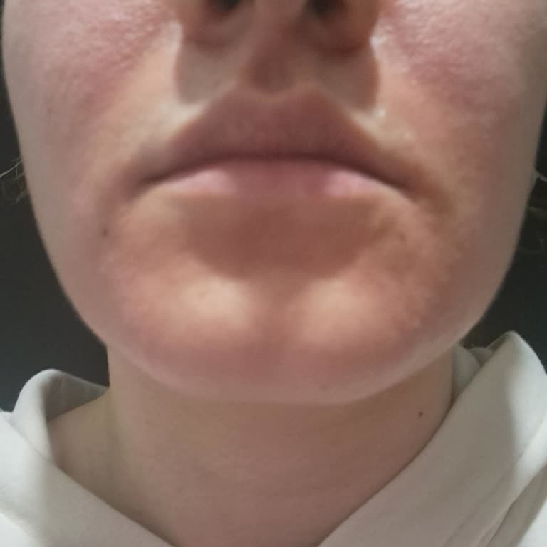 Abdi İbrahim Hametol Kremi Kullanımında Beklenmedik Cilt Reaksiyonu!