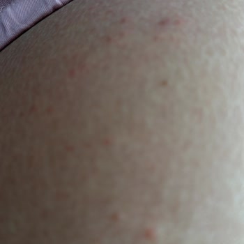 Bebek Yağı Kullanımı Sonrası Alerjik Reaksiyon