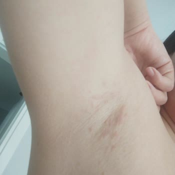 Rexona Deodorant Alerjisi: Kaşıntı Ve Kızarıklık Sorunu