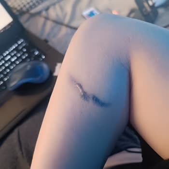 Dövme Silme Sonrası Kalıcı Hasar Şoku