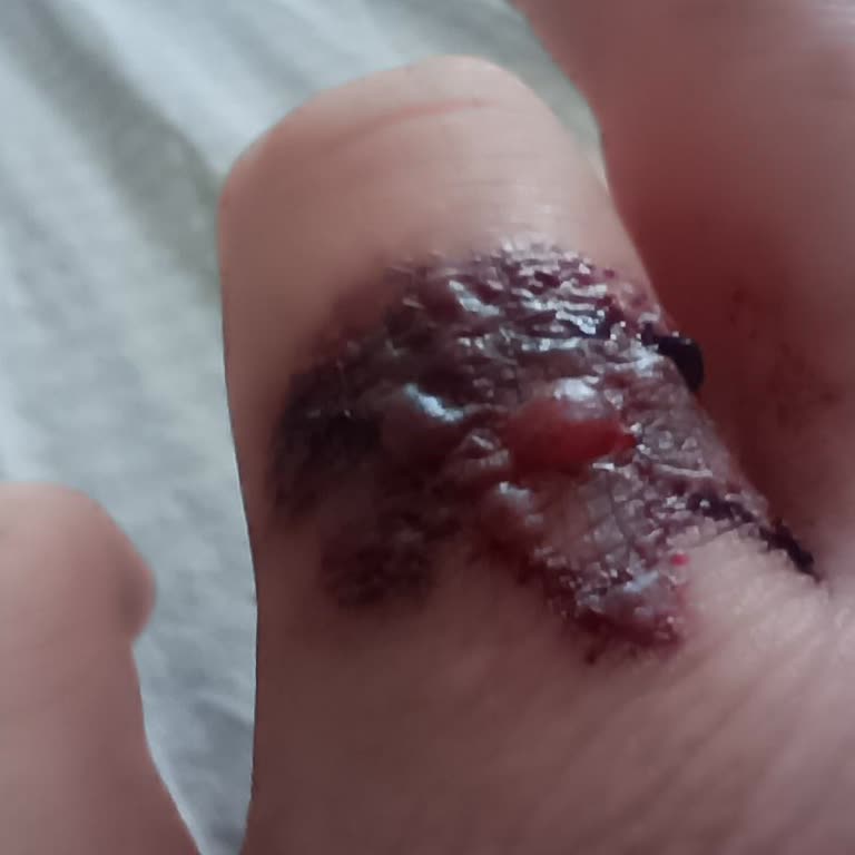 Dövme Silme Sonrası Kalıcı Hasar Şoku