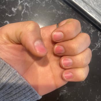 Protez Tırnak Çıkarma Kabusu: Kendi Tırnaklarım Zarar Gördü