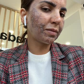 Yanlış Uygulama Sonrası Cilt Sorunları Ve Yetersiz Müşteri Hizmeti