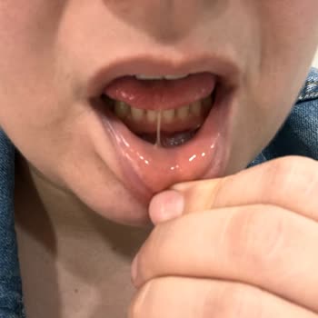 Sensodyne Sensitiv Weiß Zahncreme verursacht Hautablösungen im Mund