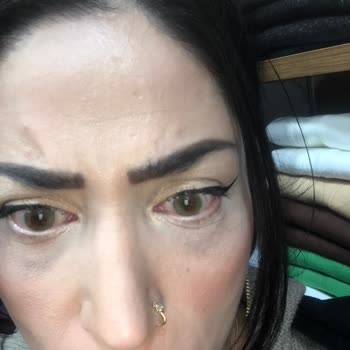 @fxeyesturkiye Hypnose Lenslerinde Kalite Sorunu Ve Kötü Müşteri Hizmeti