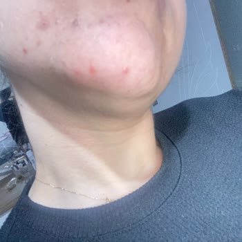 Wiwify Ürünleri Cildimi Mahvetti