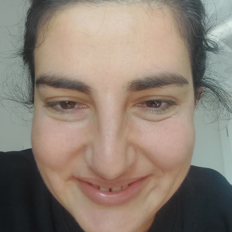 Gözaltı Işık Dolgusu Sonrası Hayal Kırıklığı Ve İletişim Eksikliği