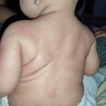 Mustela Stelatopia+ Caused Severe Skin Redness on My Baby