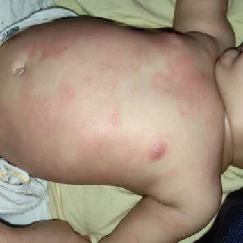 Mustela Stelatopia+ Caused Severe Skin Redness on My Baby