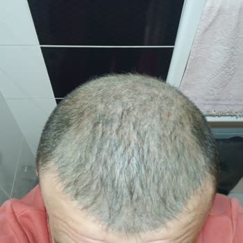 Bitkisel Boya Kabusu: Yedi Yıllık Yeşil Saç Sorunu