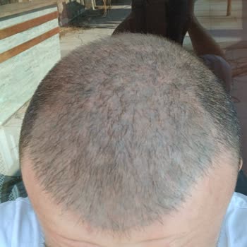 Bitkisel Boya Kabusu: Yedi Yıllık Yeşil Saç Sorunu