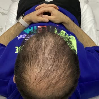 Ezgi Doğan Polikliniği Men Merkezinde Saç Tedavisi Fiyaskosu